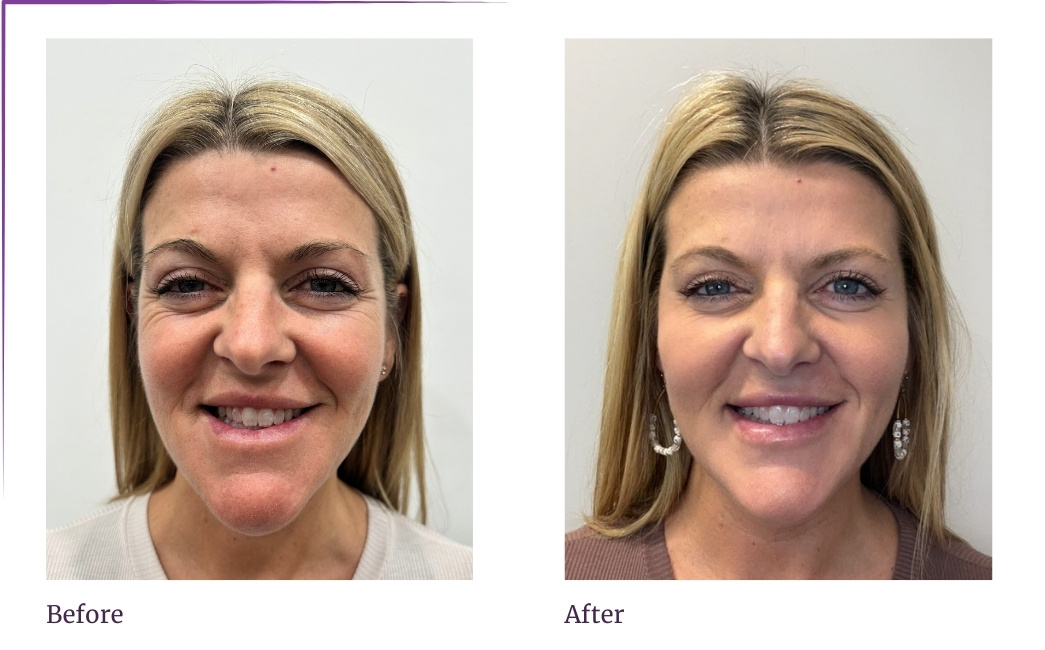 Therapeutic Use of BOTOX in Dentistry