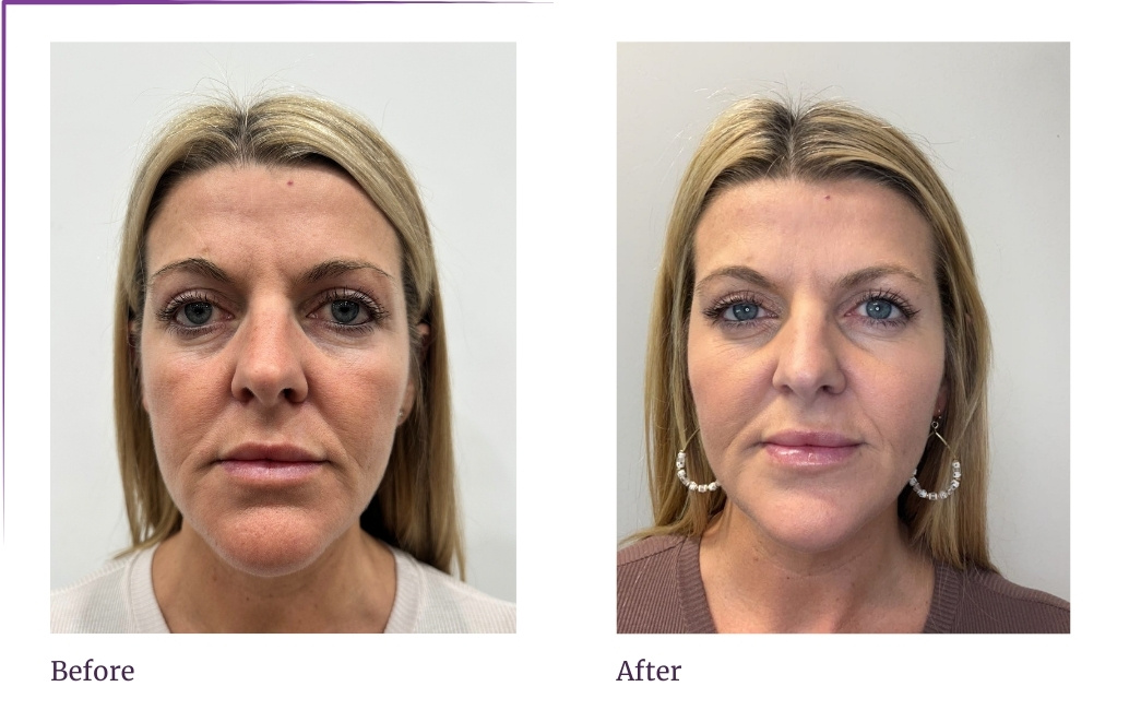 Dermal Fillers in Marlboro, NJ