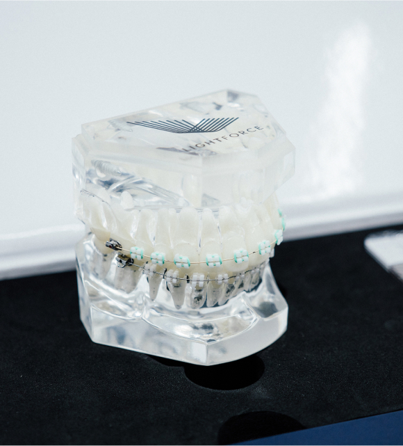 Close-up of clear ceramic brackets on teeth, showing what are LightForce braces up close